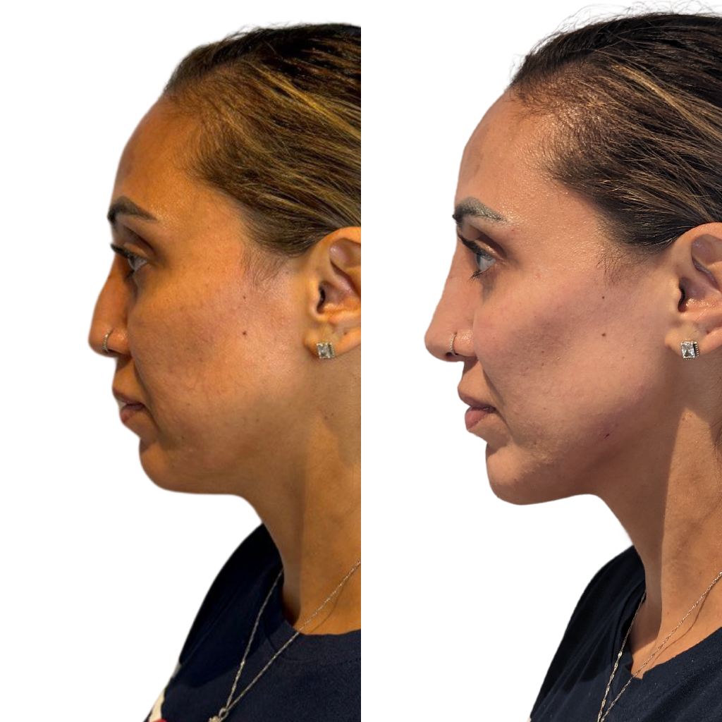 Full facial contouring with dermal filler