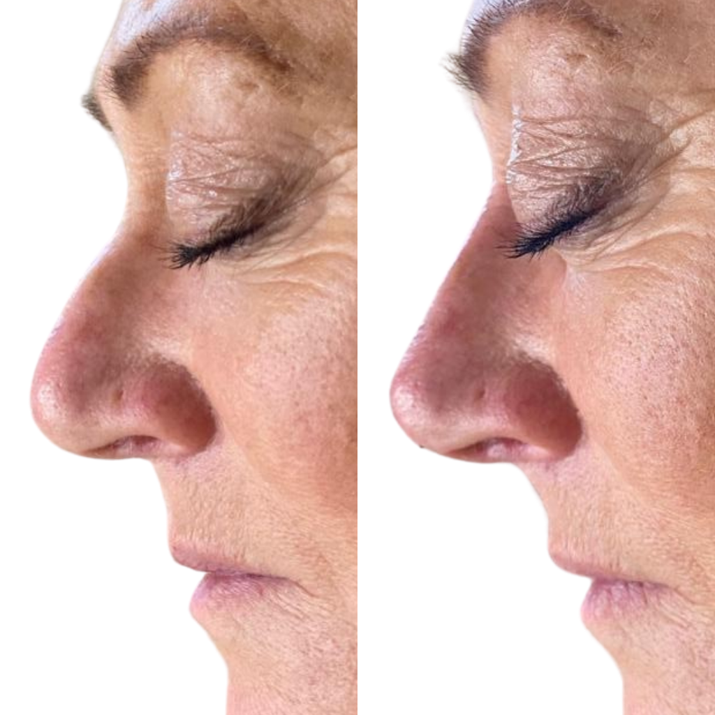 Liquid rhinoplasty or non-surgical nose job before and after